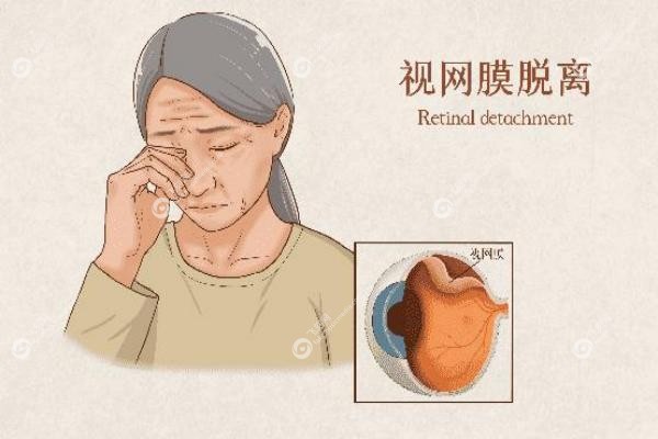 视网膜脱落手术费用大概多少钱,医 保报销吗？从1万到5万,这份省心指南请收好3