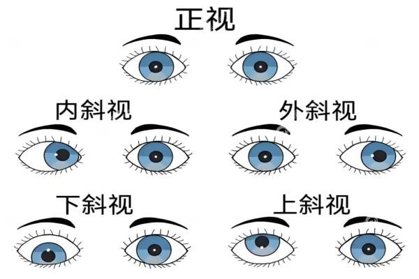 刘虎斜视手术要排很久的队吗？微信18点抢号+7天速约路径,附流程复诊指南3