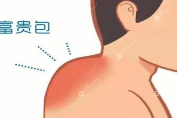 长沙微创富贵包手术医院排名.jpg 长沙微创富贵包手术医院排名.jpg