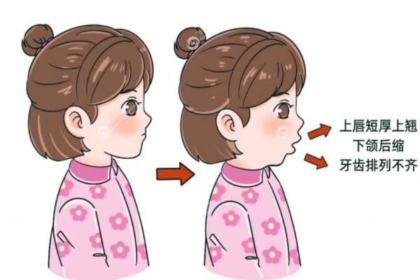 李汶洋正颌怎么样？效 果自然/创伤小/恢 复快，附过程体验及效 果解析。