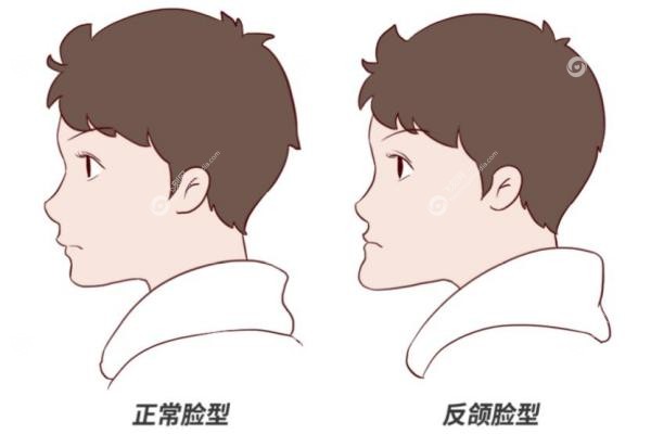 正雅gs颌位重建到底如何？一篇说透效 果、流程和是否反弹的真相3