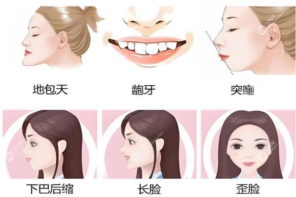 李汶洋正颌怎么样？效 果自然/创伤小/恢 复快，附过程体验及效 果解析。3