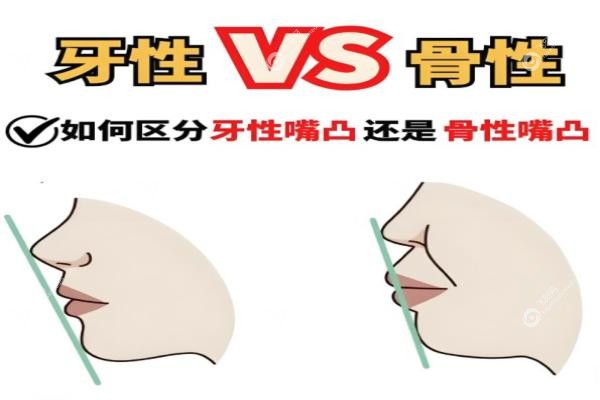 牙套还是正颌？骨性凸嘴和牙性凸嘴的区别，3分钟教你一眼分清！