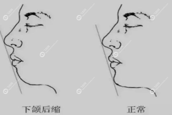 珠海下巴后缩矫正医院哪家好.jpg