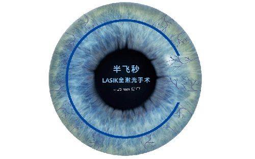 二、西安医大眼科医院晶体植入价格