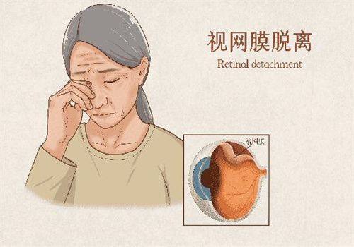 视百年护眼产品是骗局吗？否，知晓视百年护眼产品效果及一盒花费