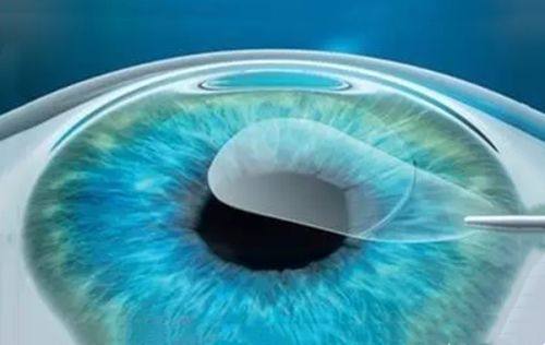 郑州尖峰眼科医院近视手术价格:半飞秒1.1/全飞秒1.5w元起！