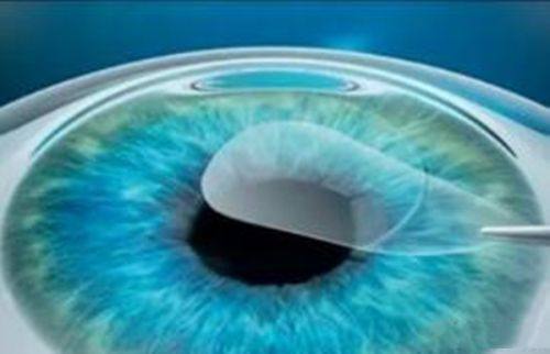 三、郑州麦迪格眼科诊所近视手术其他关注点www.fakemusicmedia.com/