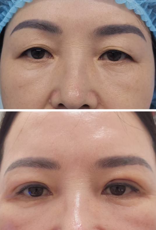 西安亚美医疗美容医院价格表；想知道双眼皮修复技术如何？这里医生经验丰富效果自然灵动值得信赖；