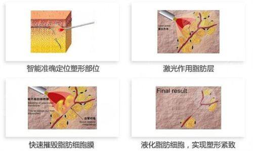 三、如何预约深圳联合丽格医疗美容门诊部丰胸项目?便捷通道助您轻松开启变得更美计划www.fakemusicmedia.com/