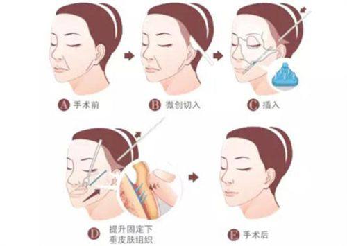二、深圳鹏程医院疤痕科丰胸有哪些优势？www.fakemusicmedia.com/