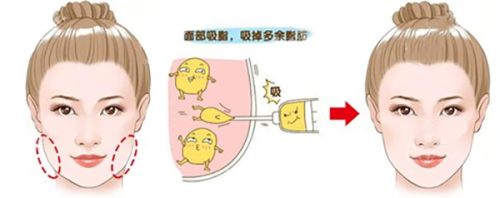 一、上海整形医院推荐？华美鼻部雕刻技术备受认可www.fakemusicmedia.com/