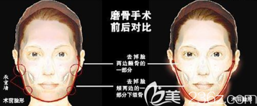 二、上海伯思立整形医院口碑怎么样？真实实例分享+贴心服务体验www.fakemusicmedia.com/