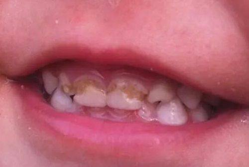 三、东莞种牙哪家医院正规靠谱