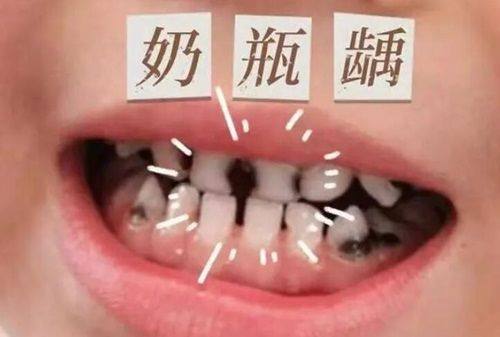 二、贺州缺牙修复数字化导板精细种牙