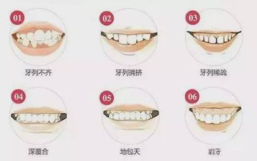 二、遂宁种牙矫正价格透明无隐形消费