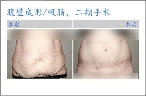 一、李如杰院长丰胸技术怎么样？个性化设计让胸部更自然www.fakemusicmedia.com/