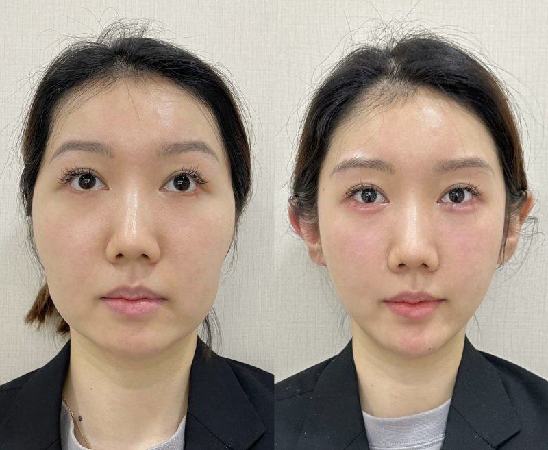 合肥国仁皮肤病医院疤痕修复中心价格表贵吗？分层修复技术好收费透明合理