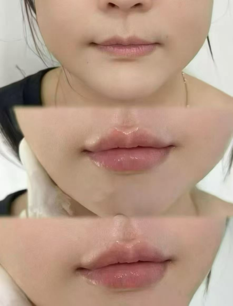 一、韩国 alive 皮肤科玻尿酸技术成熟吗？分层注射塑自然，从业多年团队保安心